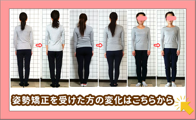 姿勢矯正ビフォーアフター